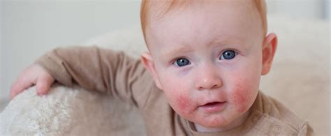 atopijski dermatitis pri dojenčku - primer izpuščaja