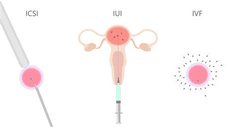 Shema metod ART: IUI, IVF, ICSI