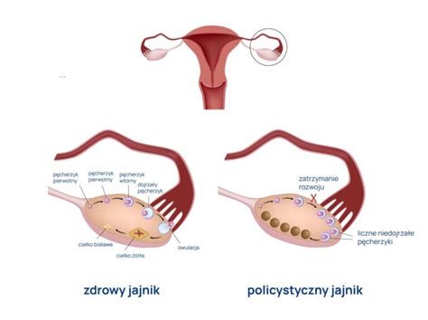 Ilustracja procedury punkcji jajników