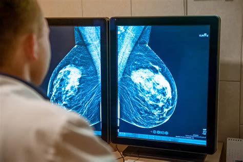 Shema mamografije: prikaz stiskanja dojke in lokacije zgostitve