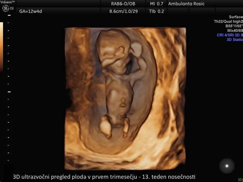 ultrazvočni pregled ploda