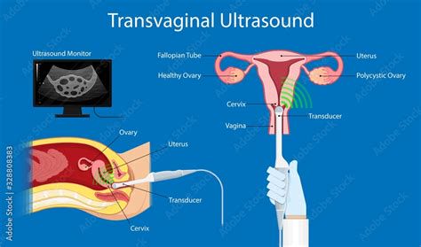 schematic-transvaginal-aspiration