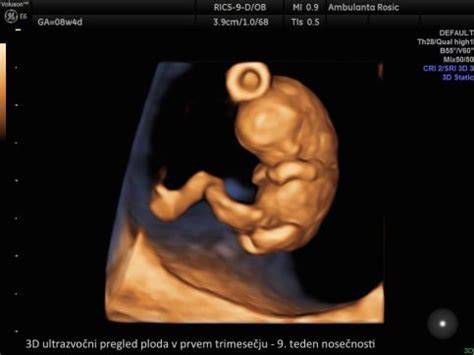 ultrazvočni pregled nosečnosti