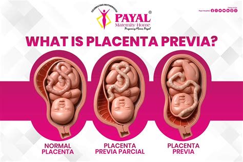 Placenta previa - slikovna ilustracija položaja posteljice v maternici