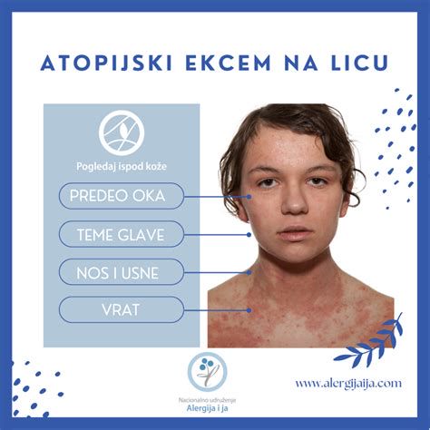 atopijski ekcem na licih dojenčka