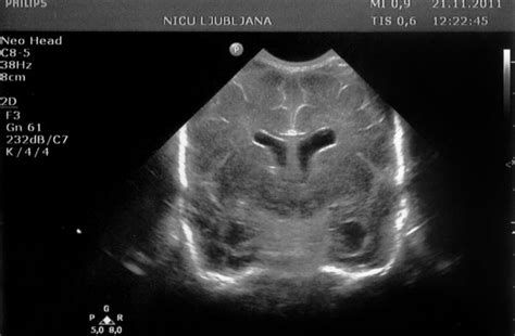 ultrazvočna slika hematoma ob posteljici
