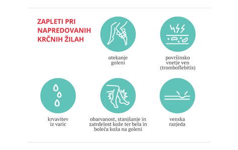 Slika človekovih krčnih žil in sprememb na koži med nosečnostjo