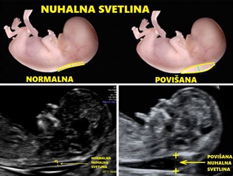 nuhalna svetlina UZ 11-14 tednov