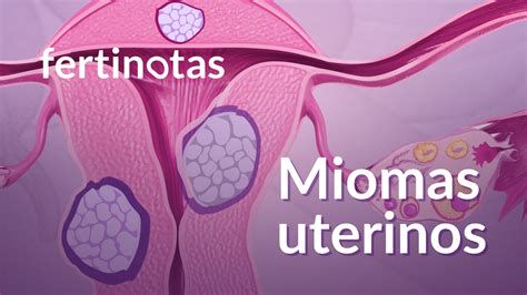 Infografika o vrstama mioma i njihovom smještaju u maternici