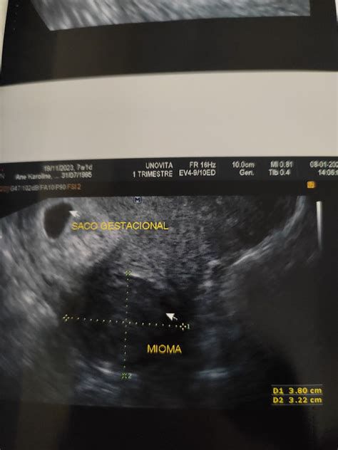 Ultrazvočna slika mioma in shema vpliva mioma na endometrij
