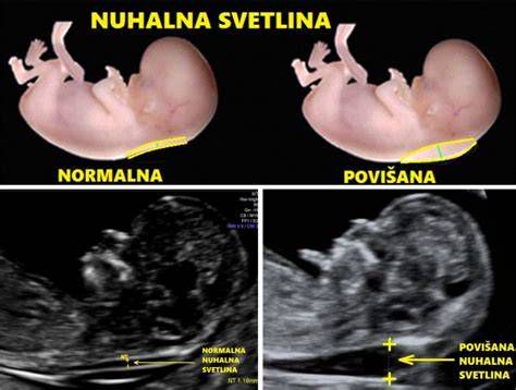 grafika presejalnih testov v nosečnosti (NIPT, nuhalna svetlina, amniocenteza)