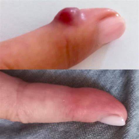 prikaz stanja pred in po laserski terapiji (nožnica pred in po)
