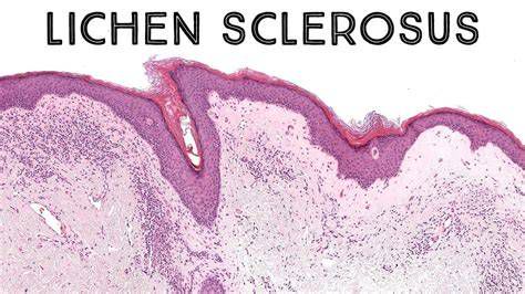 vizualizacija lichen sclerosus sprememb na vulvi pred in po terapiji