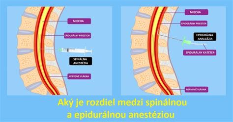 epiduralna-analgezija-shema
