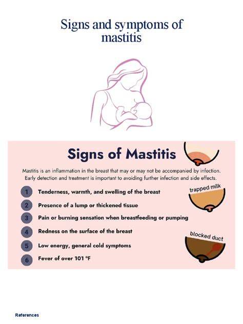 mastitis_simptomi